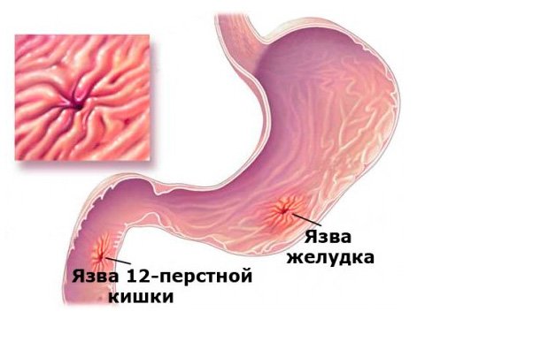 Гомеопатия при язве желудка и 12 перстной кишки thumbnail