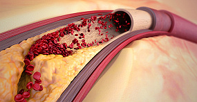 Что такое атеросклероз, факторы риска, лечение. В чем опасность